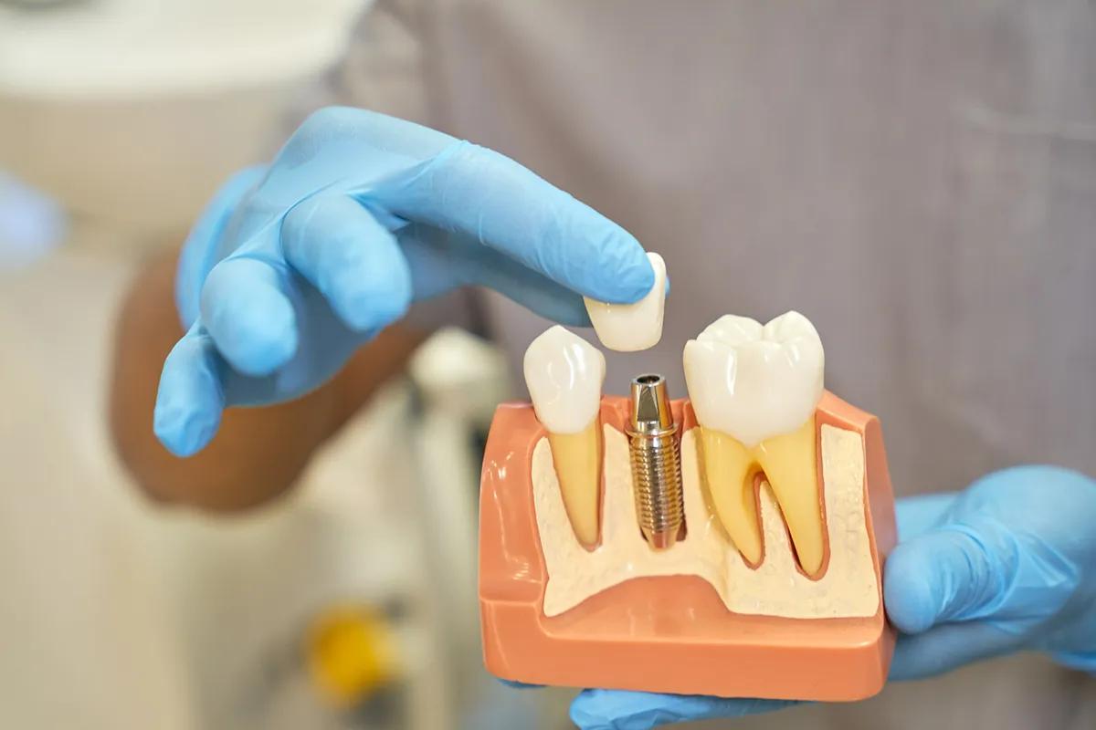 Dental Implant Consultation: What to Expect and Questions to Ask 