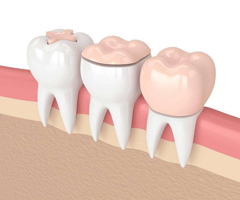 Dental Inlays and Onlays – What is the Difference?