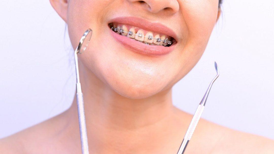 Facts and Myths About Braces