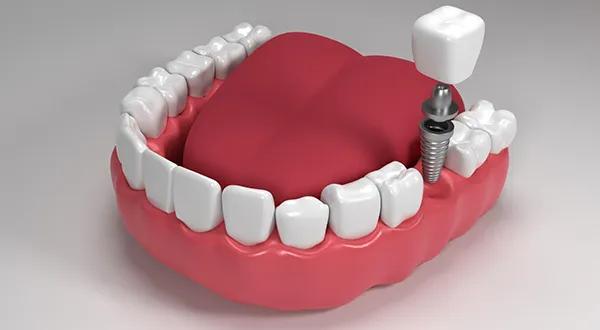 How Long Does a Dental Implant Placement Take?
