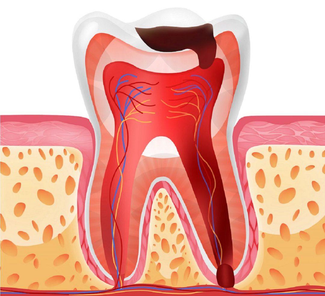 How to Reverse Periodontal Disease Naturally?