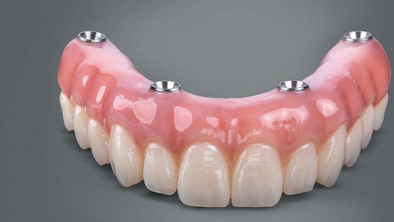 All-On-Four Full Jaw Restoration Compared to Dentures