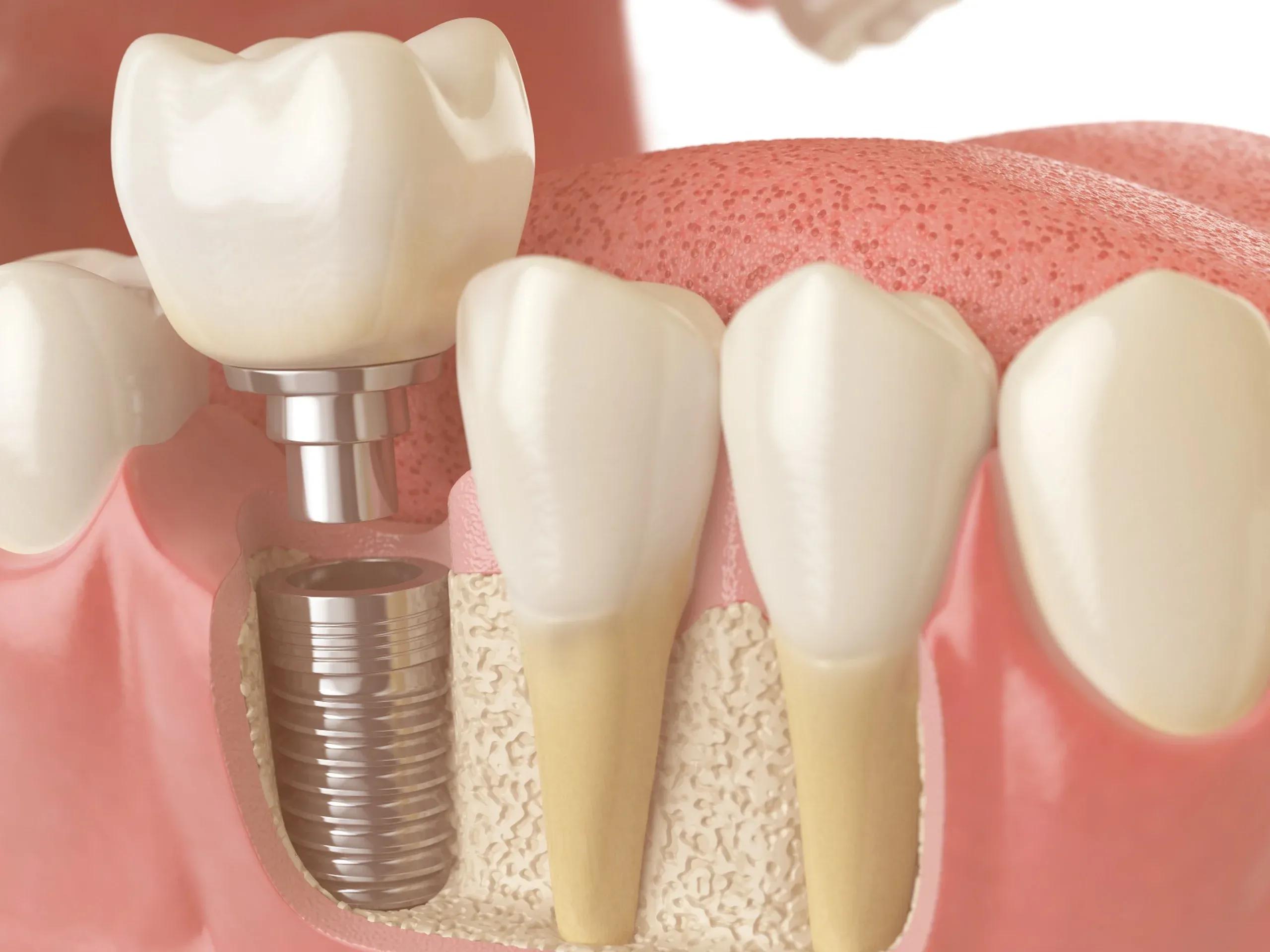 GSD-Bone-Grafting-for-Dental-Implants-Blog.webp
