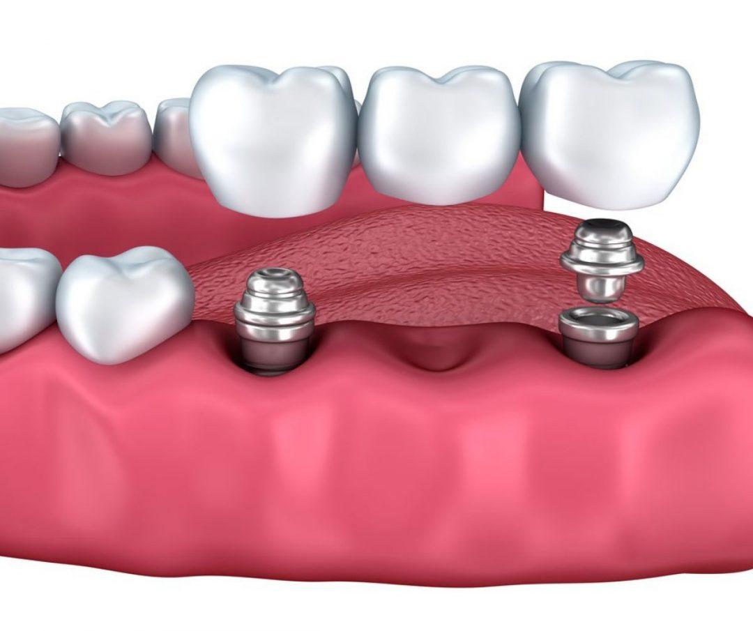 Multiple Missing Teeth and Dental Implant Options