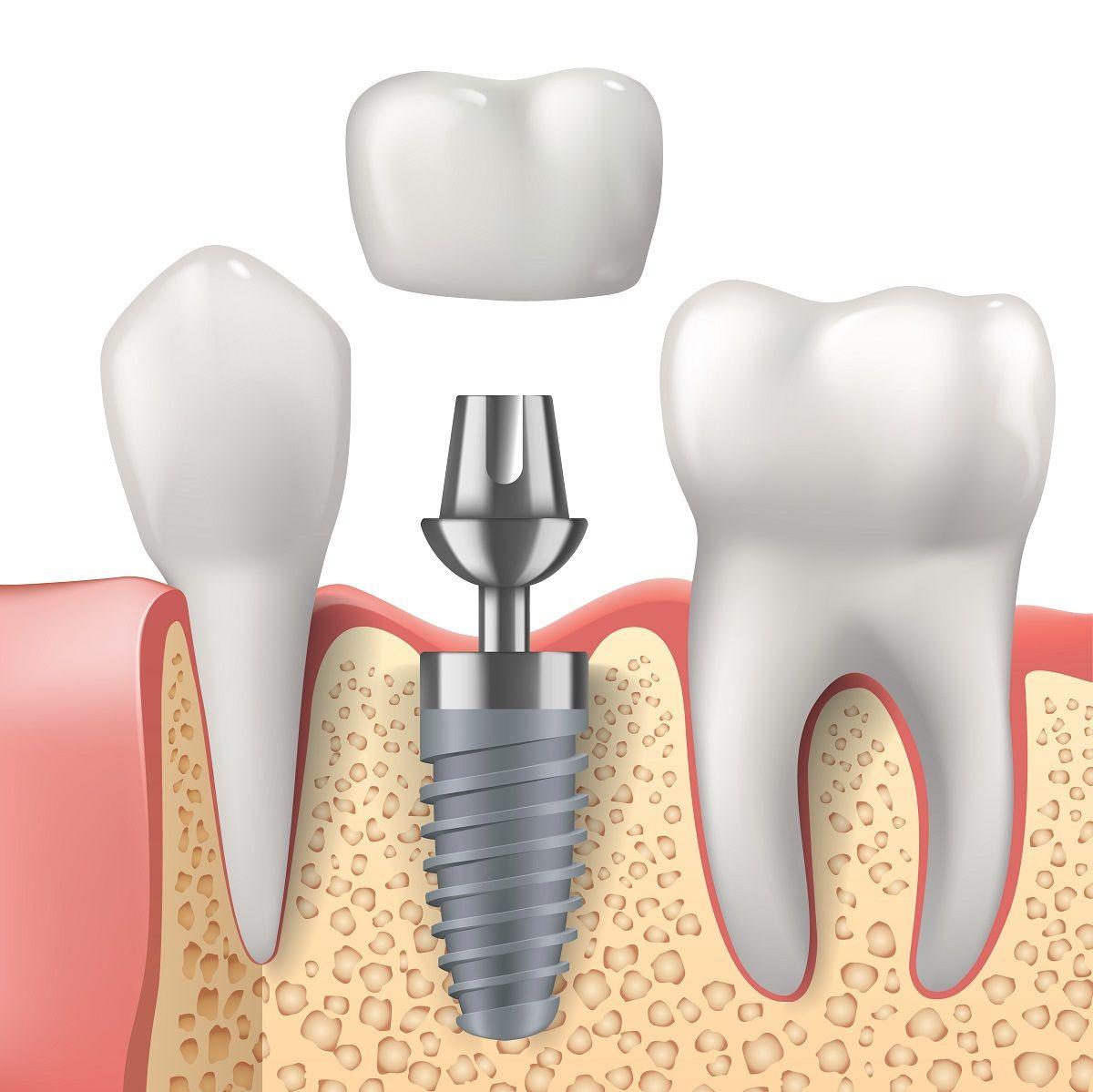 The Dental Implant Procedure: What to Expect?