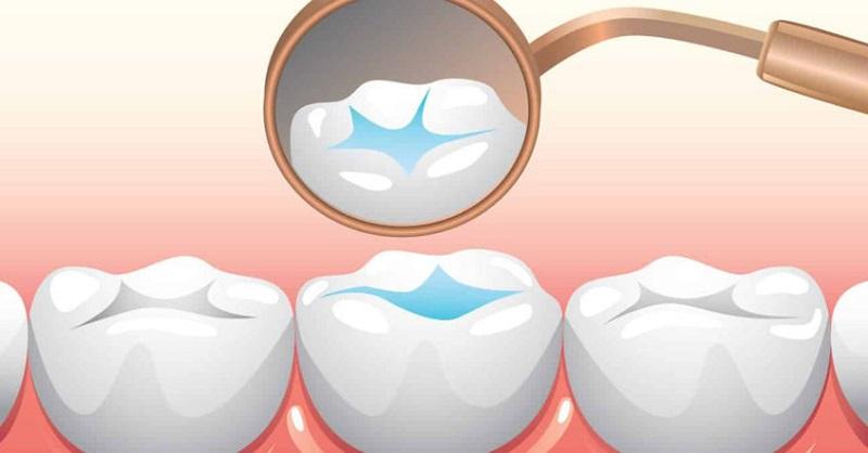 How Dental Sealants Work?