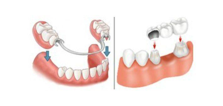 Permanent Dental Bridges Vs Partial Dentures