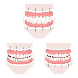 Benefits of Dentures