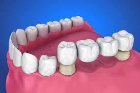 Restoration Options for Missing Teeth