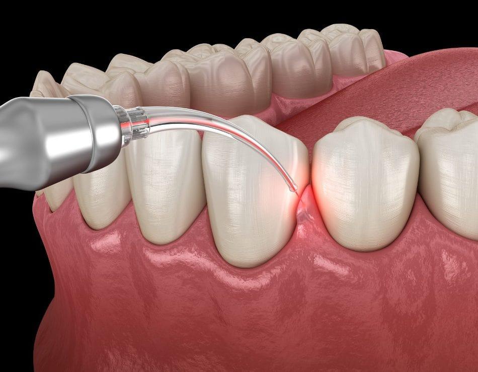 laser-periodontal-therapy.jpeg