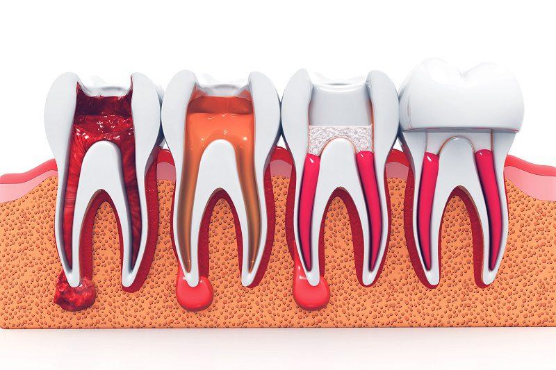 Myths About Getting Root Canals